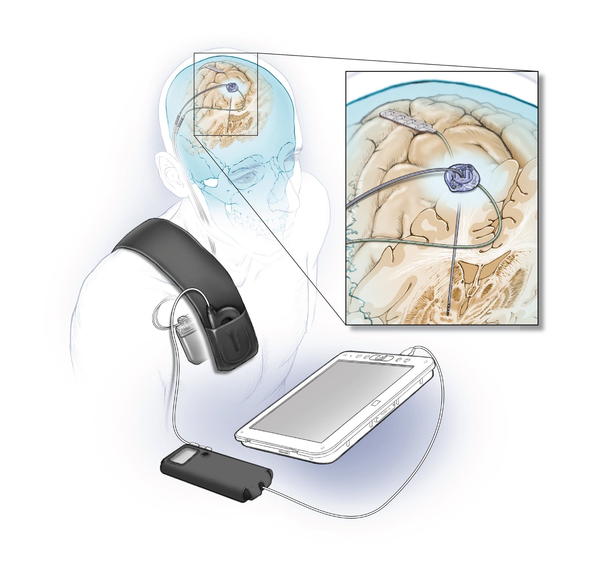 Illustration of a deep brain stimulation system with implanted brain leads and an external controller.